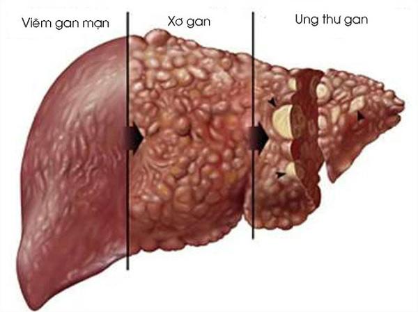Xơ gan giảm tiểu cầu - Nhận biết, Điều trị và Những điều cần biết về căn bệnh nguy hiểm này