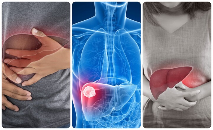 Dấu hiệu ung thư gan - Nhận biết sớm để chữa trị kịp thời