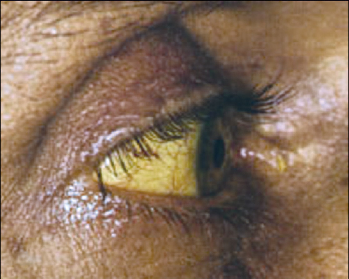 Dấu hiệu ung thư gan - Nhận biết sớm để chữa trị kịp thời