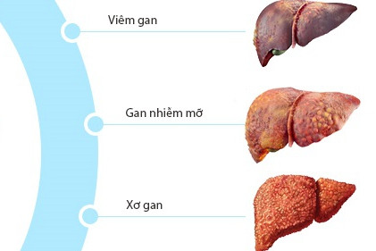 Dấu hiệu xơ gan - Nhận biết sớm để phòng tránh nguy hiểm