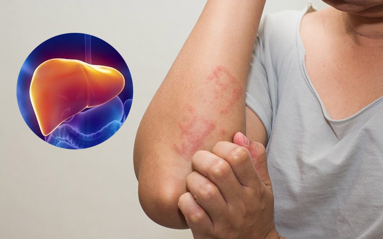 Suy Gan La Gi Hieu Dung Ve Can Benh Tiem An Va Cach Phong Tranh Hieu Qua 68fedefd9e22b.jpg