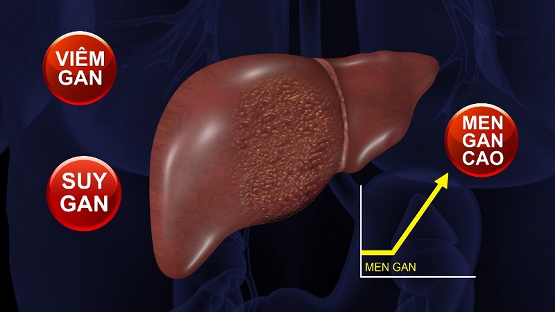 Suy gan là gì - Hiểu đúng về căn bệnh tiềm ẩn và cách phòng tránh hiệu quả
