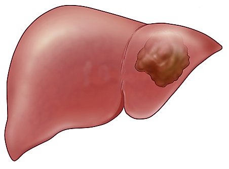Ung thư gan là gì - Hiểu đúng để phòng ngừa hiệu quả