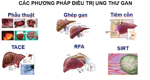 Ung thư gan là gì - Hiểu đúng để phòng ngừa hiệu quả