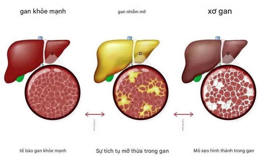 Xơ gan là gì - Hiểu đúng bệnh khám phá các biện pháp phòng tránh hiệu quả