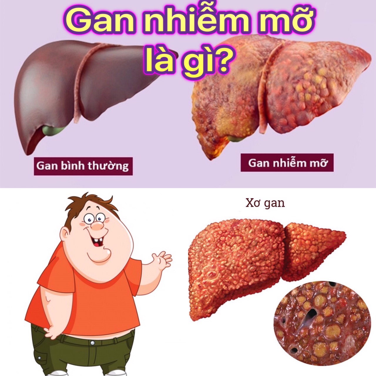 Cách phòng ngừa gan nhiễm mỡ - Bí quyết nhỏ giúp bảo vệ lá gan của bạn Cách phòng ngừa gan nhiễm mỡ - Bí quyết nhỏ giúp bảo vệ lá gan của bạn