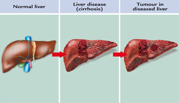 Cách phòng ngừa viêm gan - Bảo vệ sức khỏe của bạn khỏi mối đe dọa nguy hiểm Cách phòng ngừa viêm gan - Bảo vệ sức khỏe của bạn khỏi mối đe dọa nguy hiểm