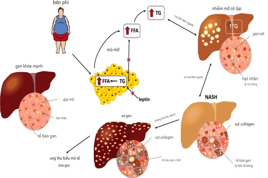 Gan nhiễm mỡ độ 1 có nguy hiểm không – Đeo bám thắc mắc của nhiều người