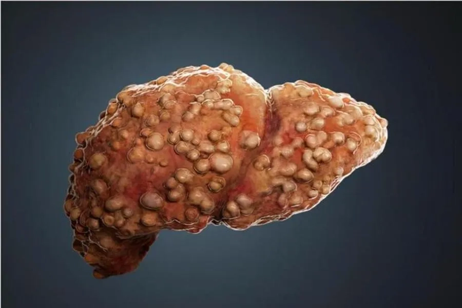 Nhận diện nguyên nhân gan nhiễm mỡ - Để có biện pháp phòng ngừa hiệu quả