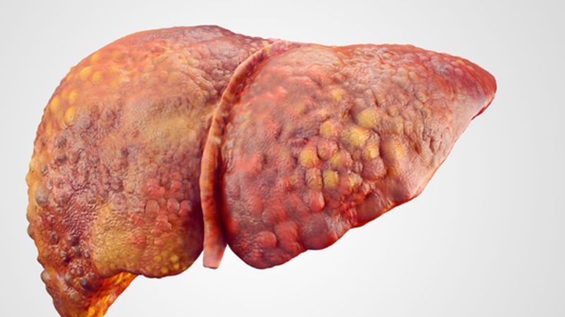 Nguyên nhân gây tăng men gan - Hiểu đúng để phòng tránh và điều trị hiệu quả