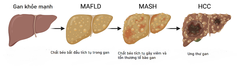 Nguyên nhân ung thư gan - Những yếu tố hàng đầu đe dọa sức khỏe của bạn