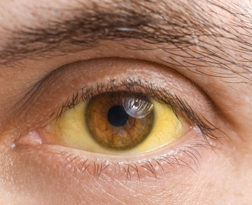 Suy gan có chữa được không? Khám phá khả năng hồi phục của bệnh lý nguy hiểm này Suy gan có chữa được không? Khám phá khả năng hồi phục của bệnh lý nguy hiểm này