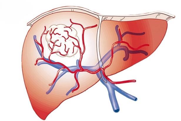 Ung thư gan giai đoạn đầu sống được bao lâu? Ung thư gan giai đoạn đầu sống được bao lâu?