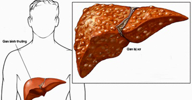 Xơ gan có chữa được không - Khám phá khả năng điều trị và hướng đi mới cho bệnh nhân