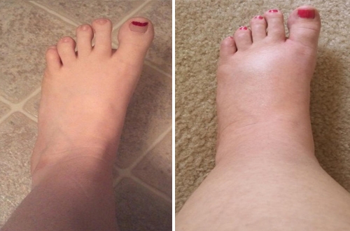 Triệu chứng suy gan giai đoạn đầu - Nhận diện sớm để xử lý kịp thời và hiệu quả