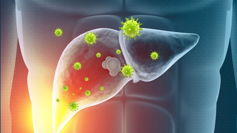 Viêm gan A và B cái nào nguy hiểm hơn – So sánh mức độ nguy hiểm giữa hai loại bệnh viêm gan phổ biến nhất hiện nay