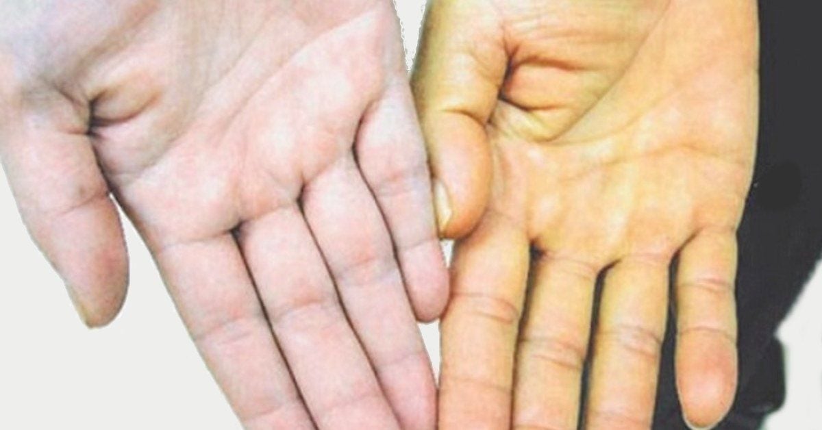 Viêm gan A và B cái nào nguy hiểm hơn – So sánh mức độ nguy hiểm giữa hai loại bệnh viêm gan phổ biến nhất hiện nay